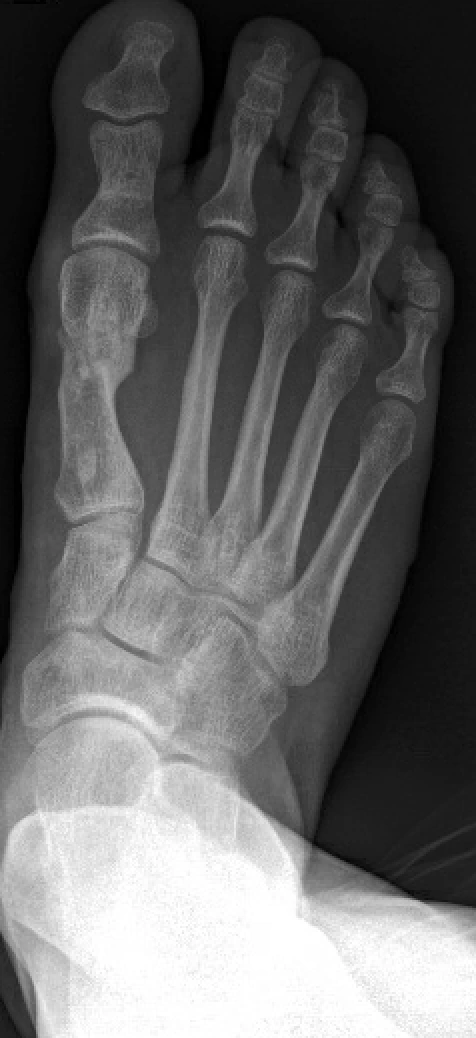Radiographie postopératoire du pied droit après correction de l’hallux valgus