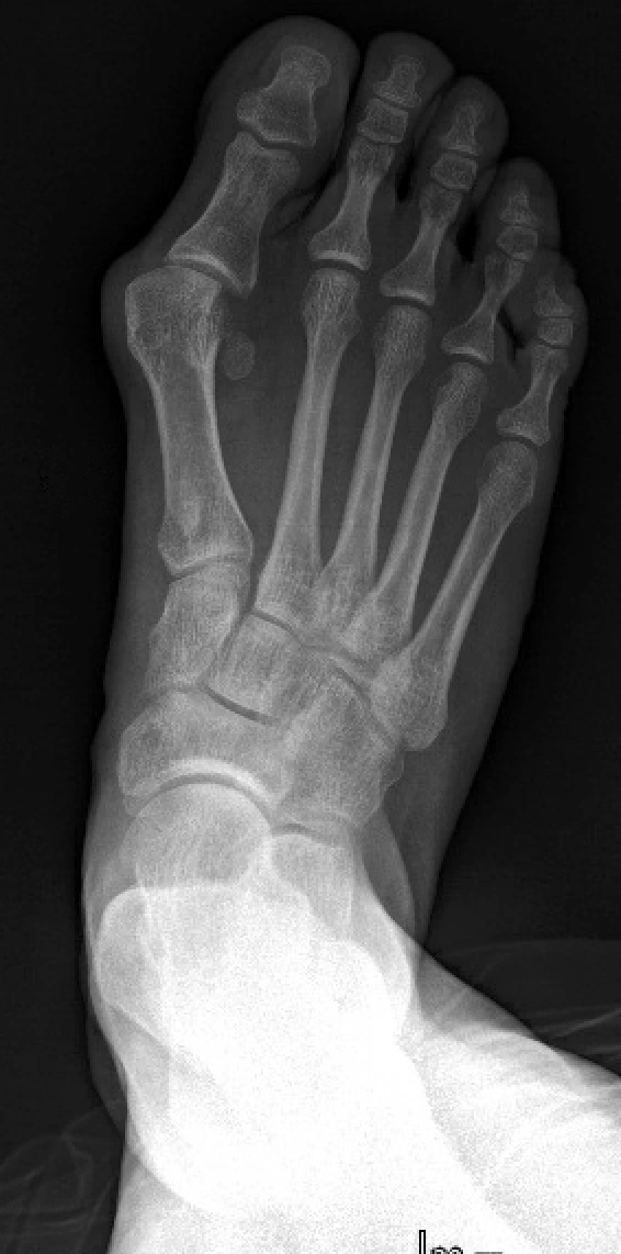 Radiographie préopératoire d’un hallux valgus du pied droit