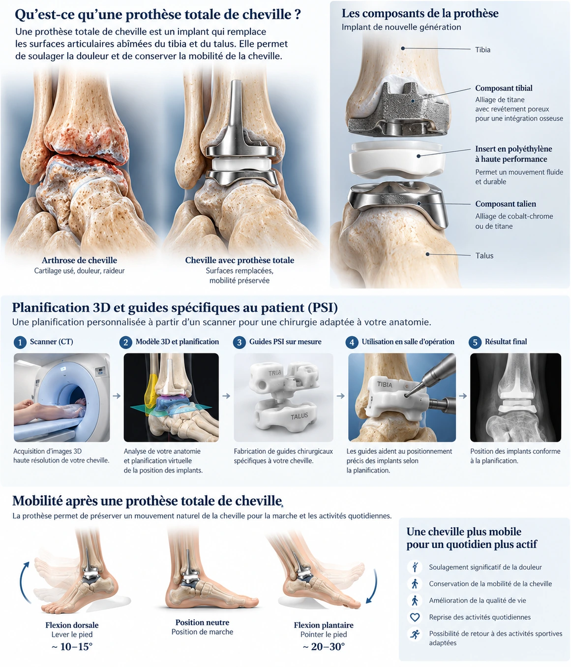 Infographie explicative sur la prothèse totale de cheville, ses composants et la planification PSI